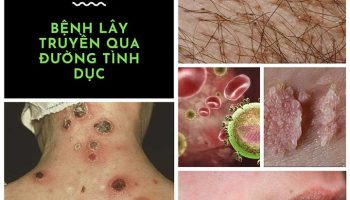 bệnh lây qua đường quan hệ tình dục