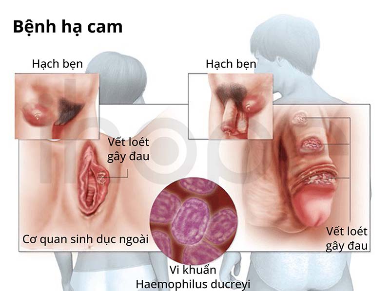 bệnh hạ cam mềm