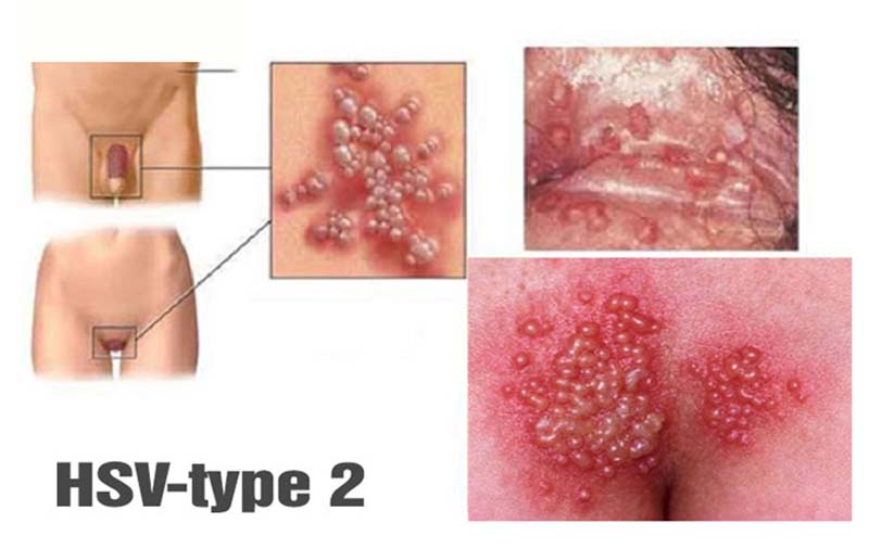 mụn rộp sinh dục