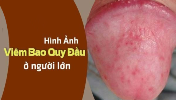 mụn viêm bao quy đầu