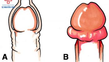 hẹp bao quy đầu nên làm gì