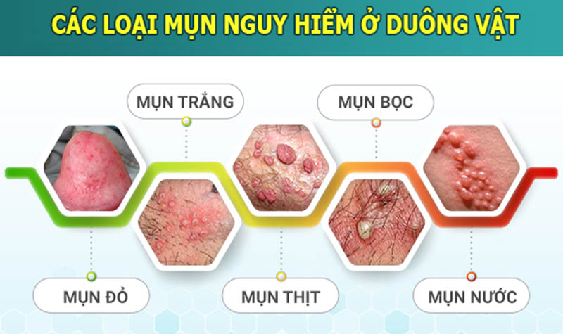 Vùng Kín Nổi Mụn Sùi Là Bị Bệnh Gì? Cảnh Báo Những Bệnh Lý Nguy Hiểm Không Nên Chủ Quan