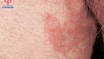 cách chữa ngứa vùng kín nam tại nhà