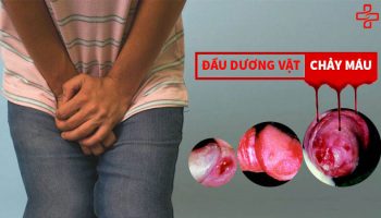 chảy máu dương vật