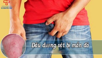 đầu dương vật nổi mẩn đỏ