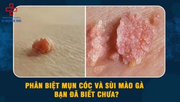 mụn cóc dương vật