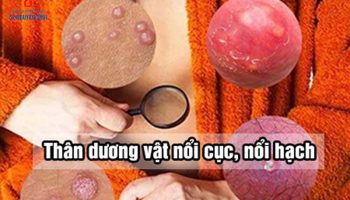 nổi cục ở dương vật