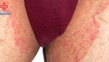 thuốc trị nấm da vùng kín nam giới