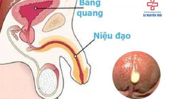 lỗ sáo bị sưng đỏ