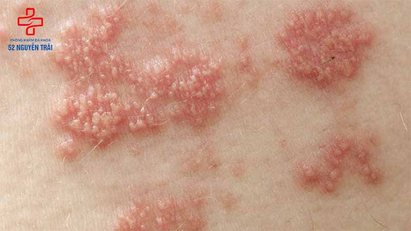Do mụn rộp Herpes