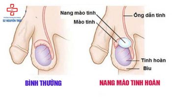 Nang tinh hoàn là gì