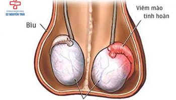 Nổi cục cứng ở bìu do viêm mào tinh hoàn