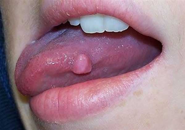 Lưỡi nổi mụn thịt cảnh báo bệnh gì? Có điều trị được không?