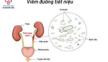 viêm đường tiết niệu