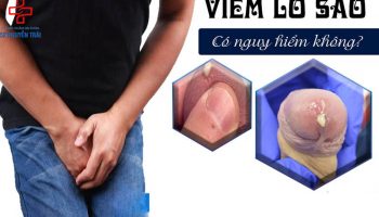 viêm lỗ sáo