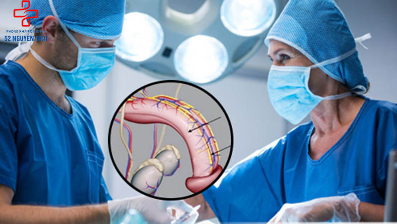 Phẫu thuật cắt dây thần kinh dương vật công nghệ Mỹ