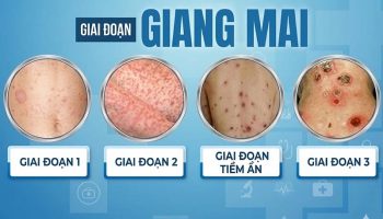 các giai đoạn bệnh giang mai