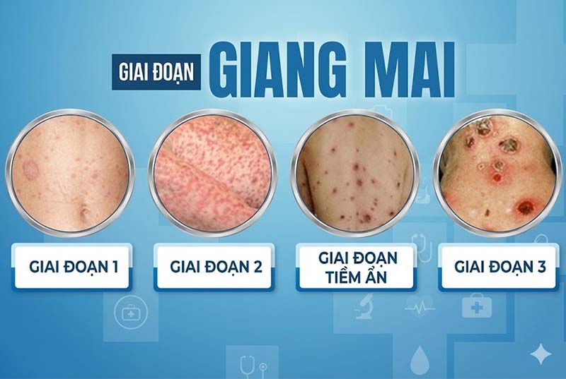 Bệnh Giang Mai: Nguyên Nhân, Dấu Hiệu và Cách Điều Trị Hiệu Quả