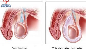 Tràn dịch tinh hoàn là gì