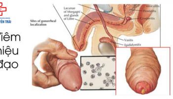 Nguyên nhân gây viêm niệu đạo ở nam giới