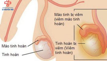 Viêm tinh hoàn là gì