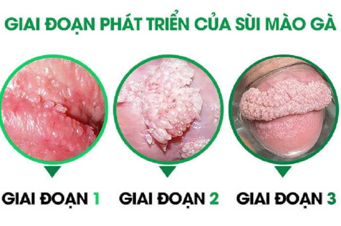 Các giai đoạn của bệnh sùi mào gà