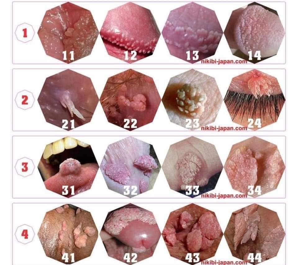 Mụn cóc sinh dục
