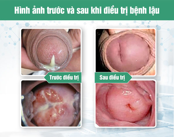 điều trị tiểu ra mủ