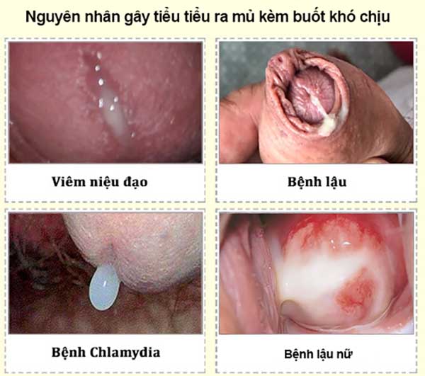 Nguyên nhân tiểu ra mủ