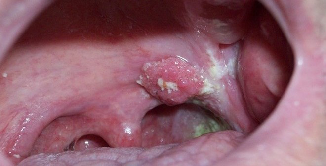 hpv gây ung thư vòm họng