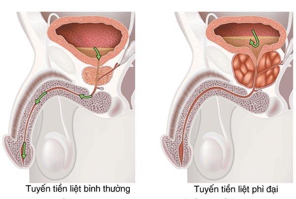 Tiểu ra máu ở nam do phì đại tiền liệt tuyến