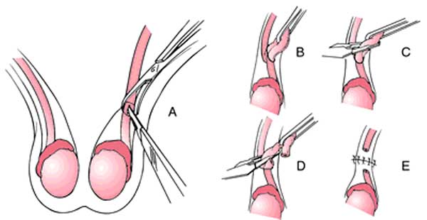 quy trình thắt ống dẫn tinh