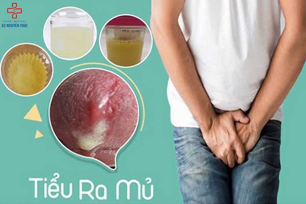 Tiểu ra mủ có nguy hiểm không? Nguyên nhân và cách chữa tiểu ra mủ