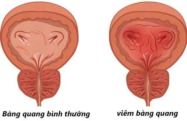 Viêm bàng quang