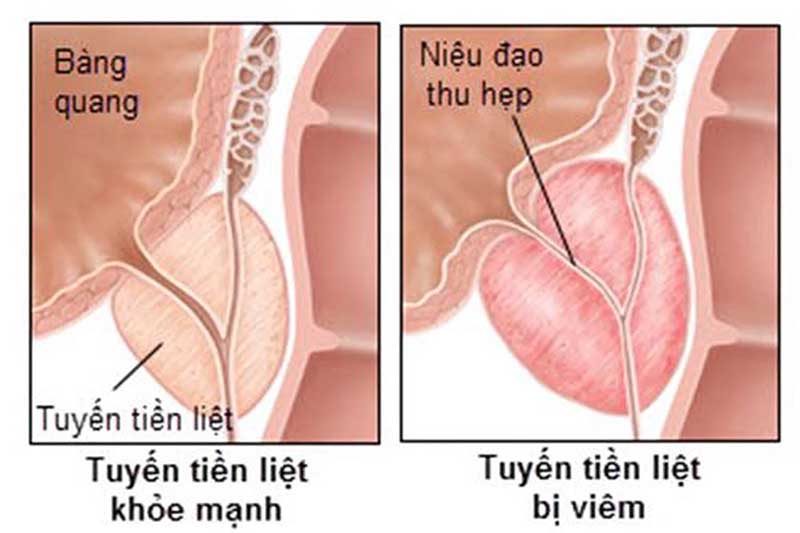 viêm tuyến tiền liệt