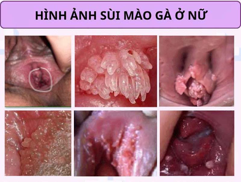 SÙI MÀO GÀ NỮ