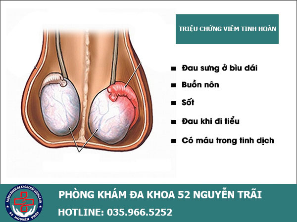 Bệnh viêm tinh hoàn: Chẩn đoán nguyên nhân, triệu chứng và cách điều trị