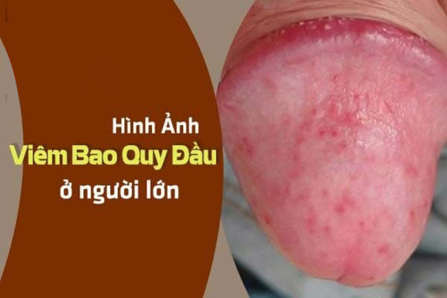 viêm bao quy đầu