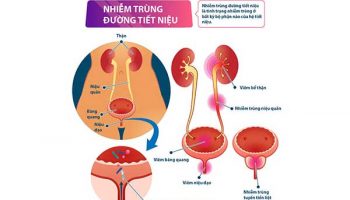 nhiễm trùng đường tiết niệu