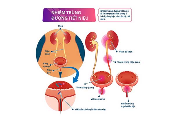 Nhiễm trùng đường tiết niệu: Triệu chứng, nguyên nhân và cách điều trị