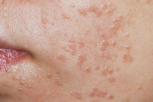 mụn cóc phẳng trên mặt