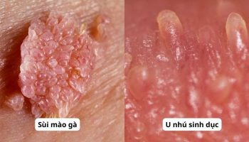 u nhú sinh dục và sùi mào gà