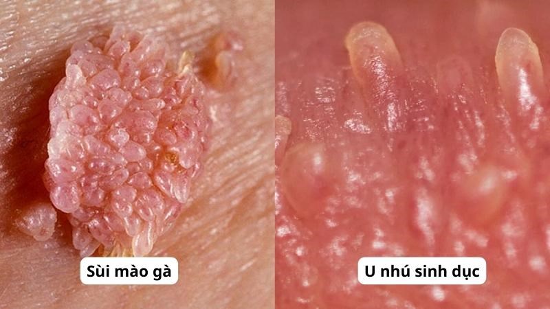 U nhú sinh dục (u nhú vùng kín) có nguy hiểm không? Có lây không?