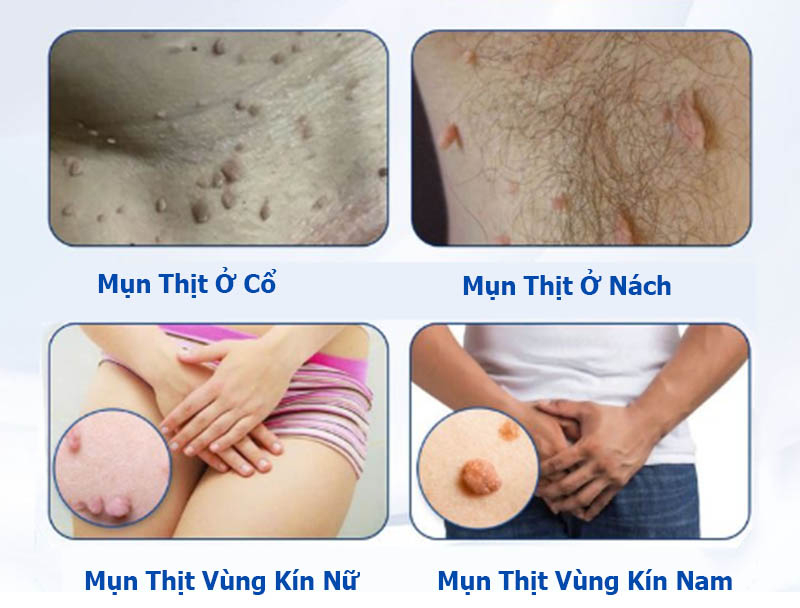 Các loại mụn thịt