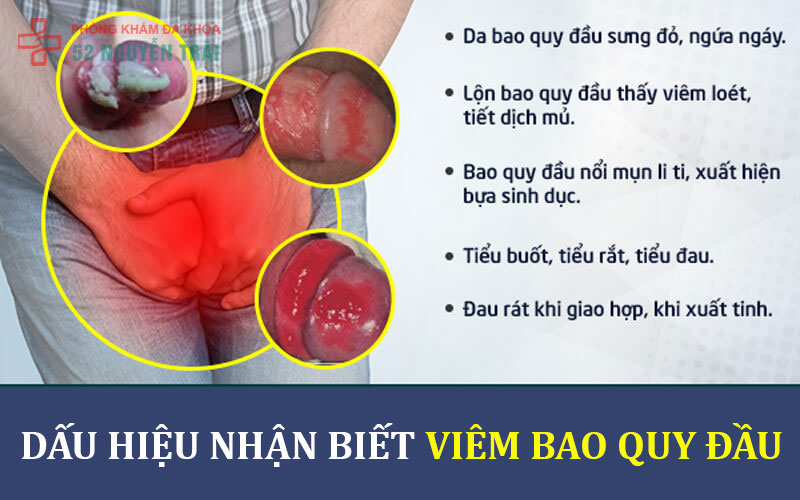 Viêm bao quy đầu