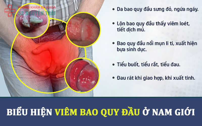 dấu hiệu viêm bao quy đầu