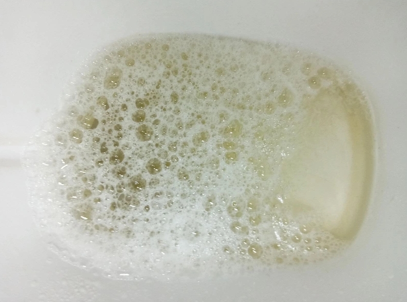 Đi tiểu buốt có bọt là bệnh gì? có nguy hiểm không