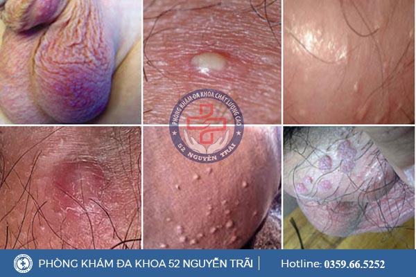 Nổi mụn ở vùng bìu