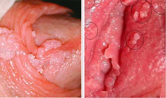 Mụn thịt ở vùng kín báo hiệu bệnh gì? Cách xử lý như thế nào?