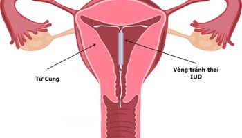 đặt vòng tránh thai